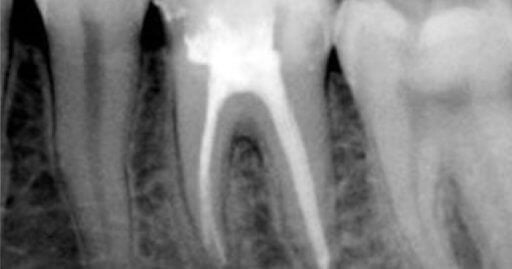 HH Hancock III Root Canal Endodontist in Raleigh NC -