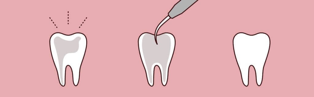 root canal raleigh north carolina endodontics root canal raleigh