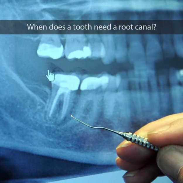 Root Canal