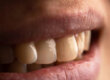 Raleigh endodontist cracked tooth