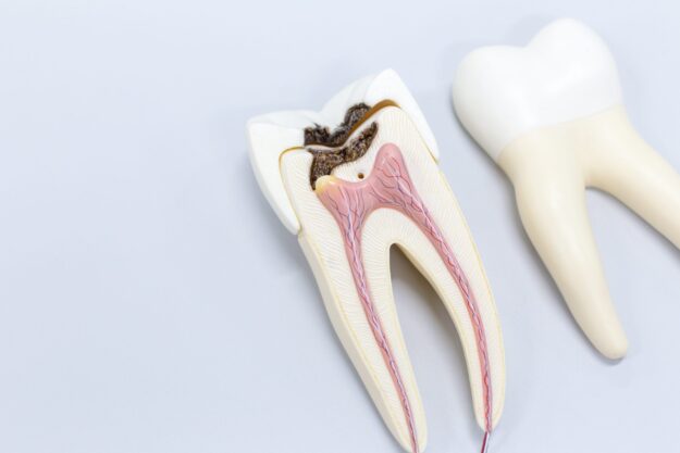 North Raleigh endodontics root canal