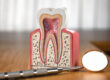 North Carolina endodontics